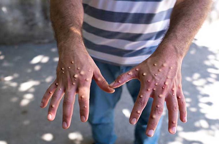 کراچی میں منکی پاکس کا پہلا مشتبہ کیس رپورٹ