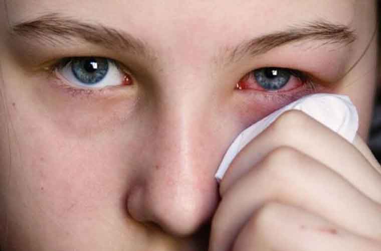 آشوب چشم : احتیاط ضرور کیجئے مگر خود علاج کرنے سے پرہیز کریں