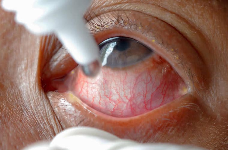 آشوب چشم: پنجاب میں جعلی انجیکشن لگنے سے متعدد افراد کی بینائی چلی گئی