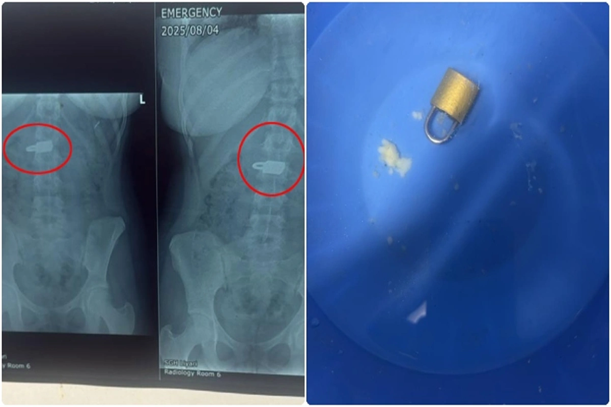 کراچی لیاری جنرل اسپتال میں خاتون کے پیٹ سے بنا سرجری تالا نکال لیا گیا