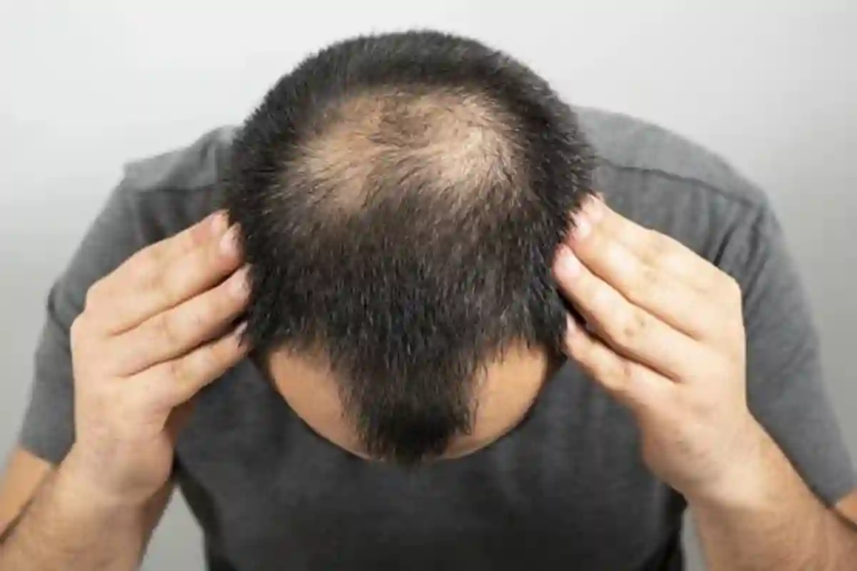 گنج پن کے مریضوں کیلئے بڑی خوشخبری آگئی