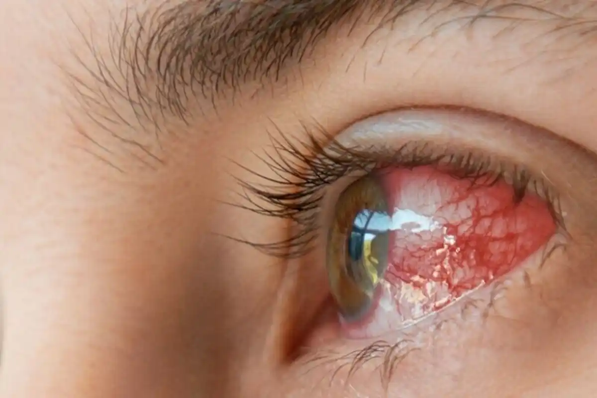 کراچی میں آشوبِ چشم کے کیسز میں تیزی سے اضافہ