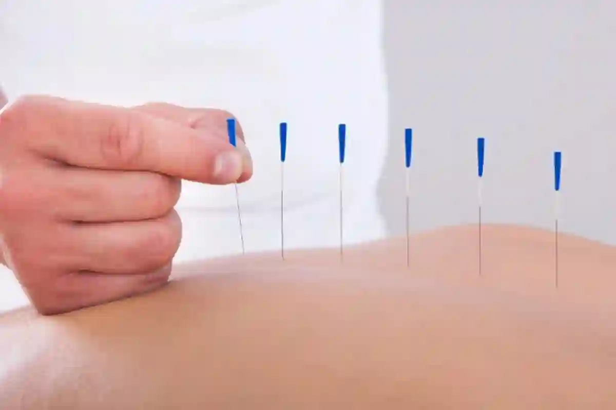 ایکیوپنکچر کیا ہے اور کینسر کے مریضوں کیلئے کیسے مددگار ہے؟ مکمل تفصیلات جانیں