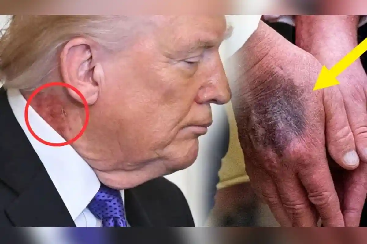 گردن اور ہاتھ پر اچانک سرخ اور کالے نشانات نمودار، ٹرمپ کی صحت سے متعلق وائٹ ہاؤس میں نئی ہلچل مچ گئی