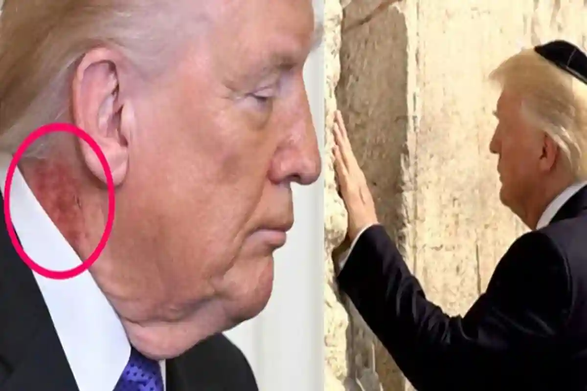 امریکی صدر ٹرمپ کے کان کے پاس موجود اس نشان کا ایران امریکا اسرائیل جنگ سے کیا تعلق ہے؟ بڑی خبر آگئی