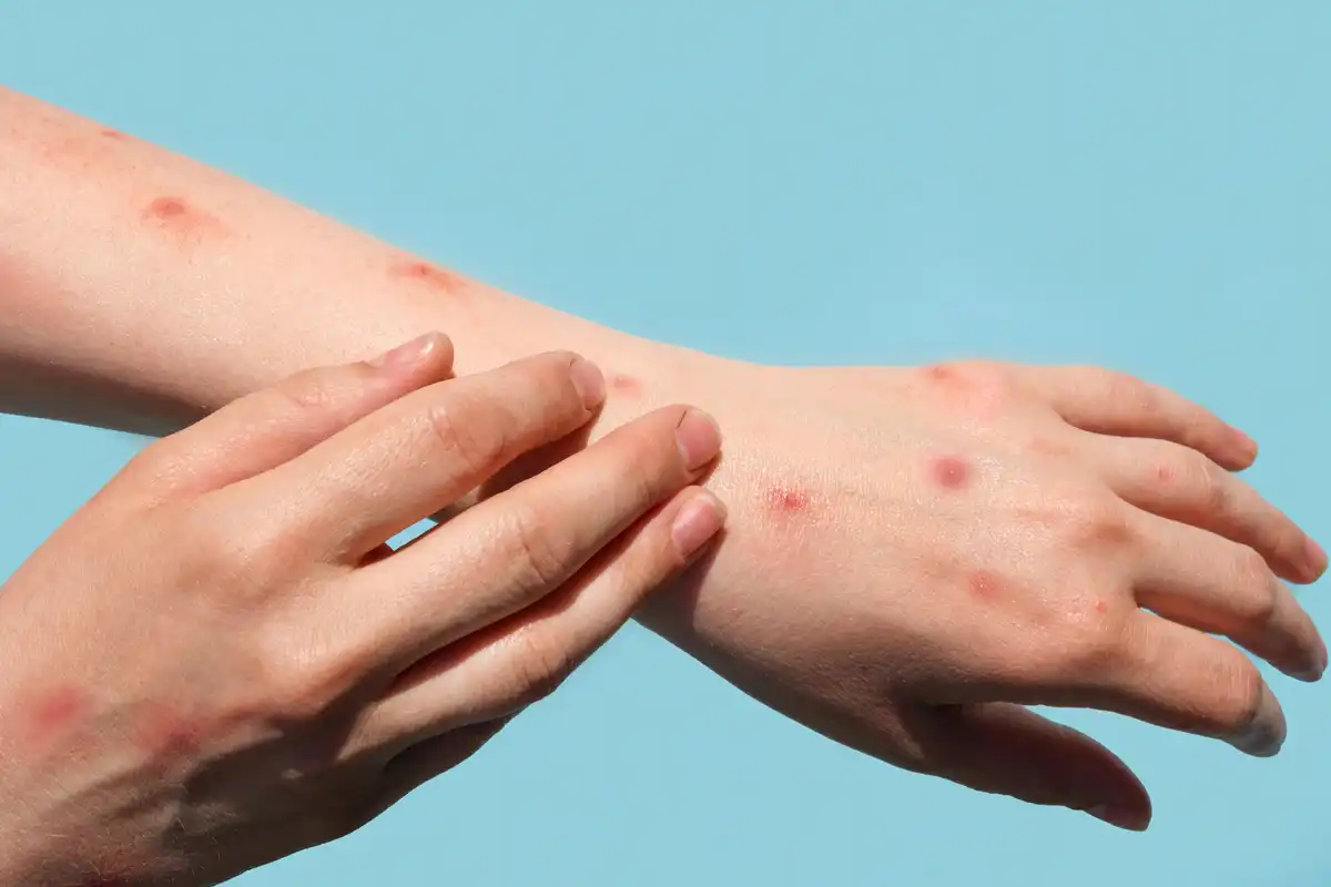 کراچی میں ایم پاکس کا ایک اور کیس رپورٹ، سندھ میں کیسز کی تعداد 27 تک پہنچ گئی