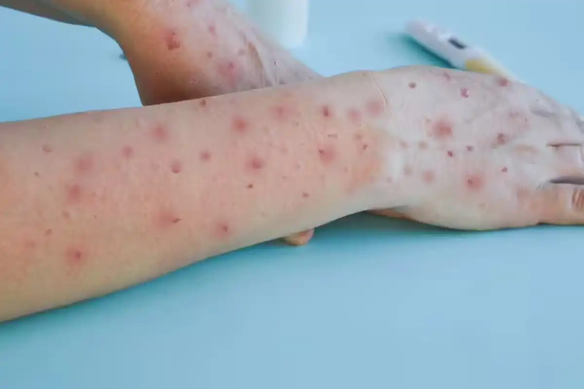 کراچی میں ایم پاکس کے مزید مشتبہ کیسز کی رپورٹ