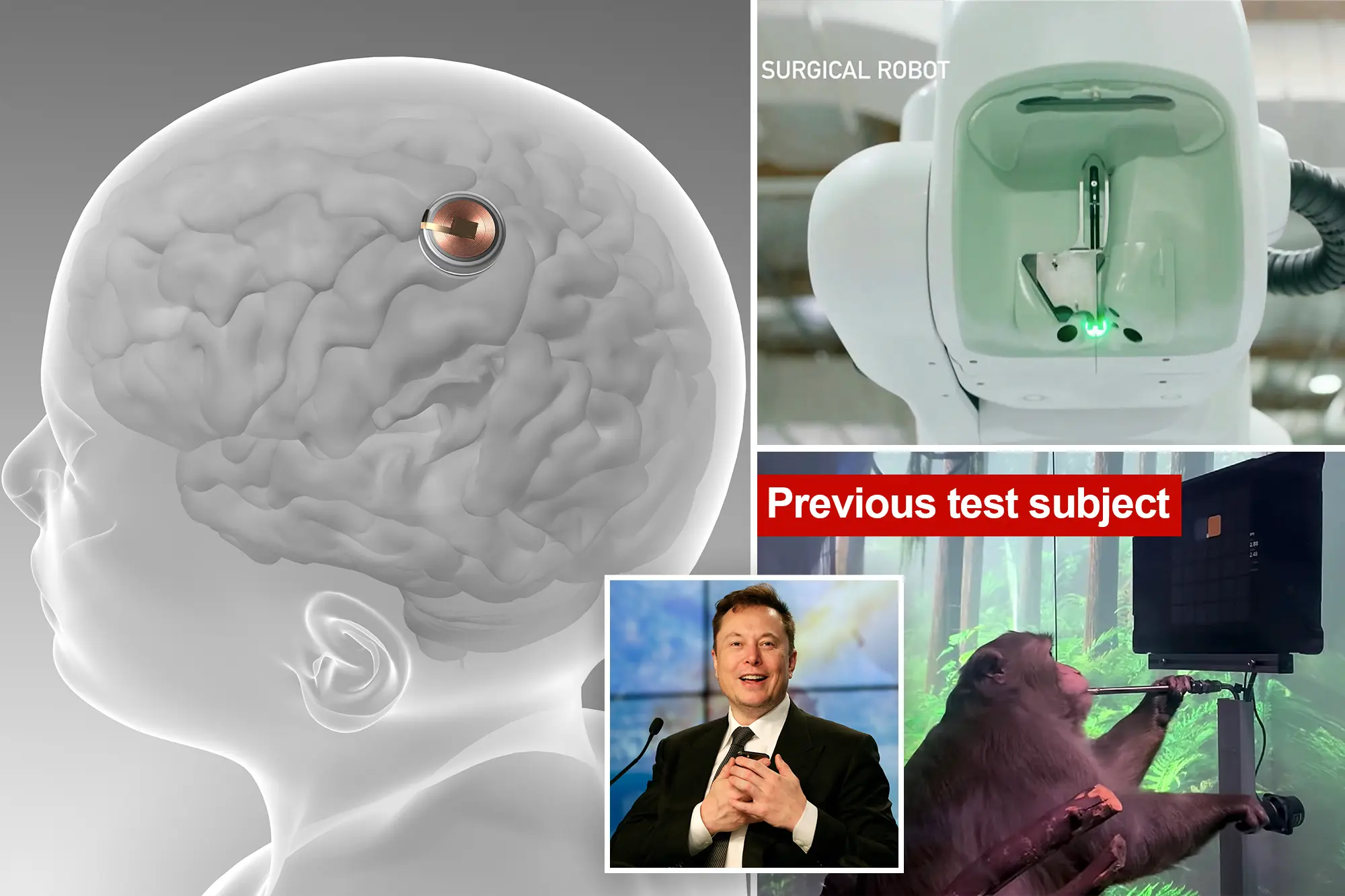 Brain chip installed in a human patient, Elon Musk