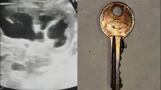 Boy undergoes surgery after accidentally swallowing key