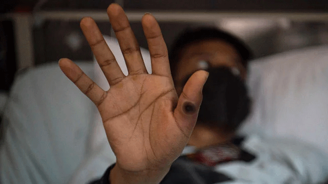 Monkeypox diagnosed patient flees in KP