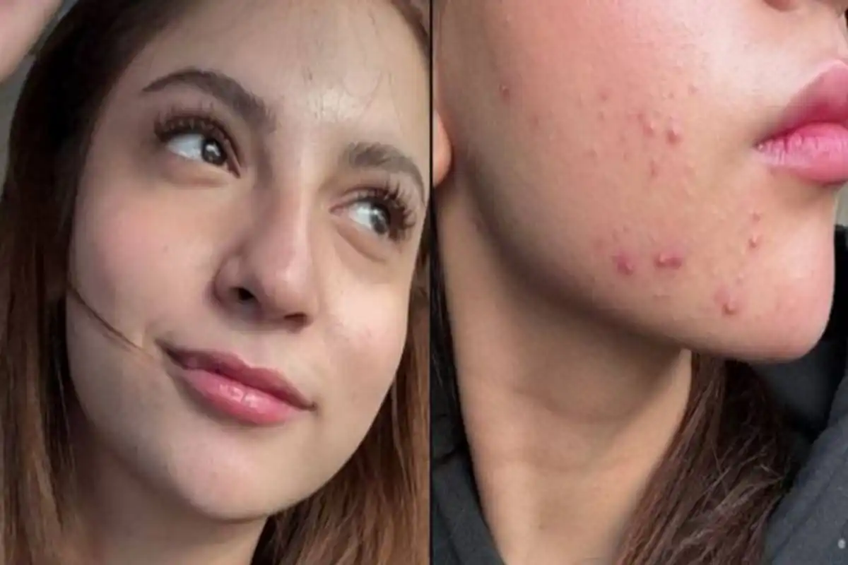 Dananeer Mobeen’s Unfiltered Thoughts on Skin Imperfections